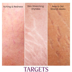 Close-up comparison of skin with redness, dryness, and stretch marks, Safrin Skin Care stretch mark treatment.