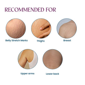 Infographic showing areas with stretch marks: belly, thighs, breast, upper arms, lower back.