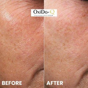 OxiDo-Q Coenzyme Q10 Serum before and after results on facial skin, Safrin Skin Care Pakistan