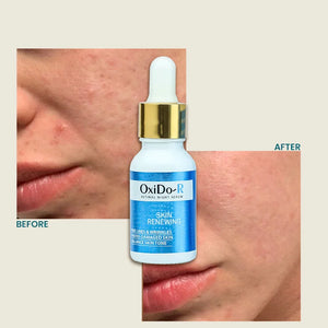 OxiDo-R retinol night serum before and after skin results by Safrin Skin Care