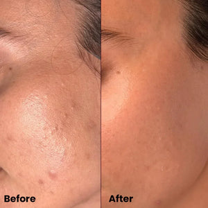 Before and after close-up of cheek showing reduced acne and smoother skin with Safrin Skin Care product.