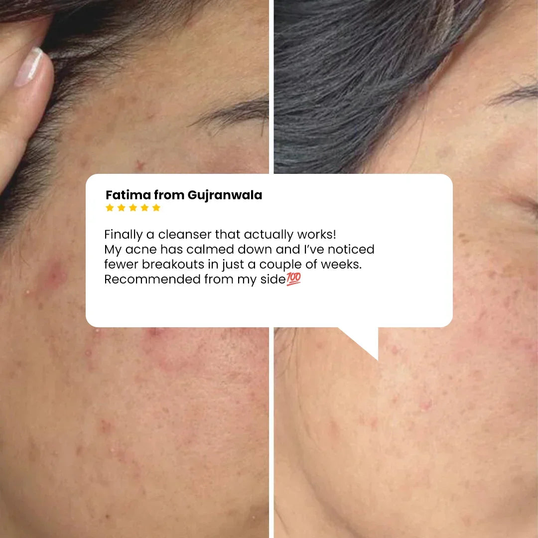 Safrin Skin Care acne cleanser before and after results with customer review highlighting reduced breakouts.
