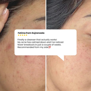 Safrin Skin Care acne cleanser before and after results with customer review highlighting reduced breakouts.