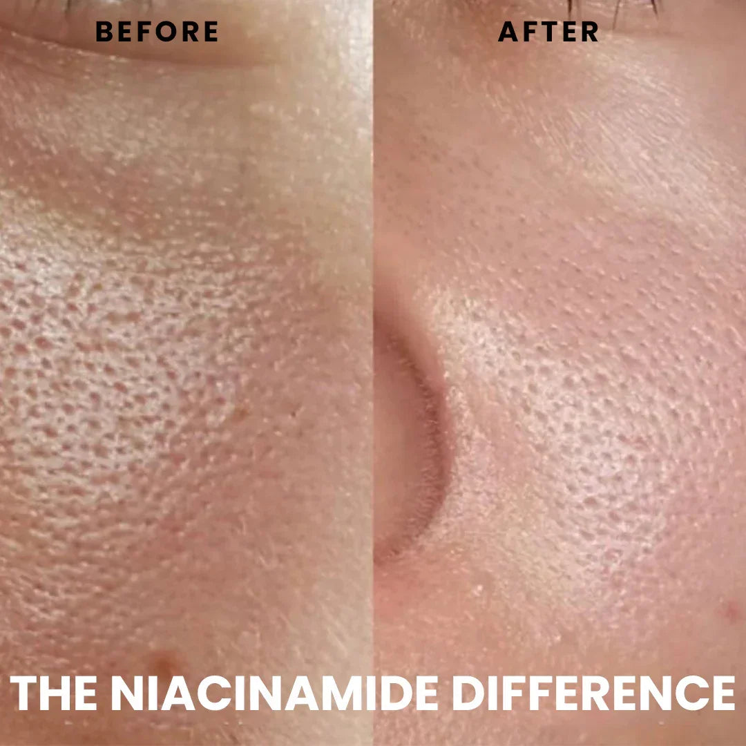 Close-up before and after of skin showing reduced pores with Safrin Skin Care niacinamide.